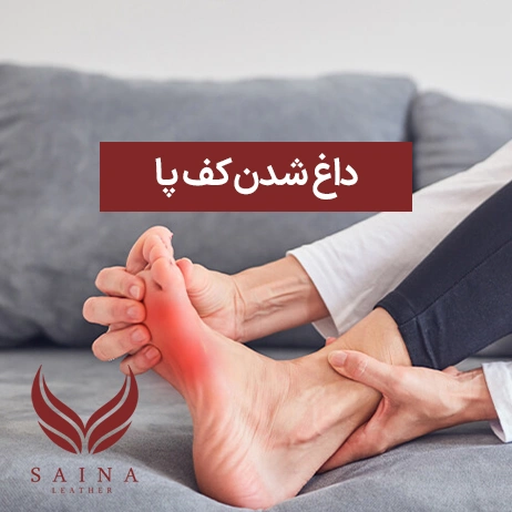 داغ شدن کف پا