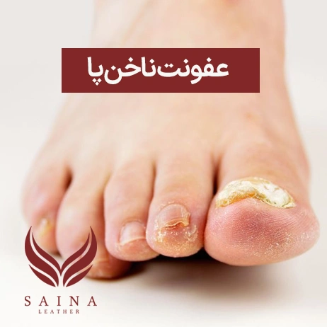 عفونت ناخن پا